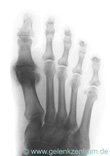 Hallux rigidus R&ouml;ngtenbild