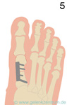 Hallux rigidus post OP